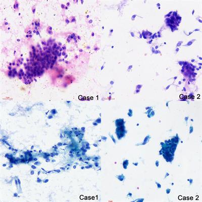 Pulmonary metastasis of stage I, low-grade endometrioid carcinoma: two case reports and the literature review